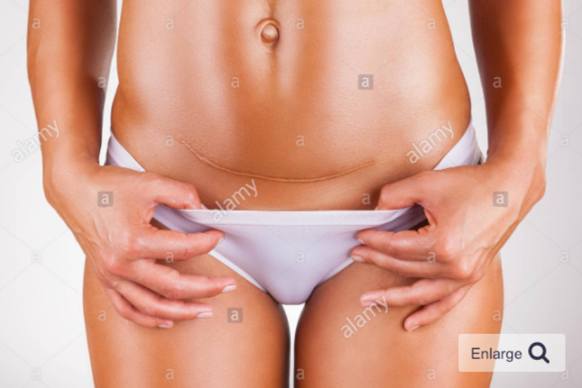 Healing for scars, c-section scars | pelvic floor physio orange county