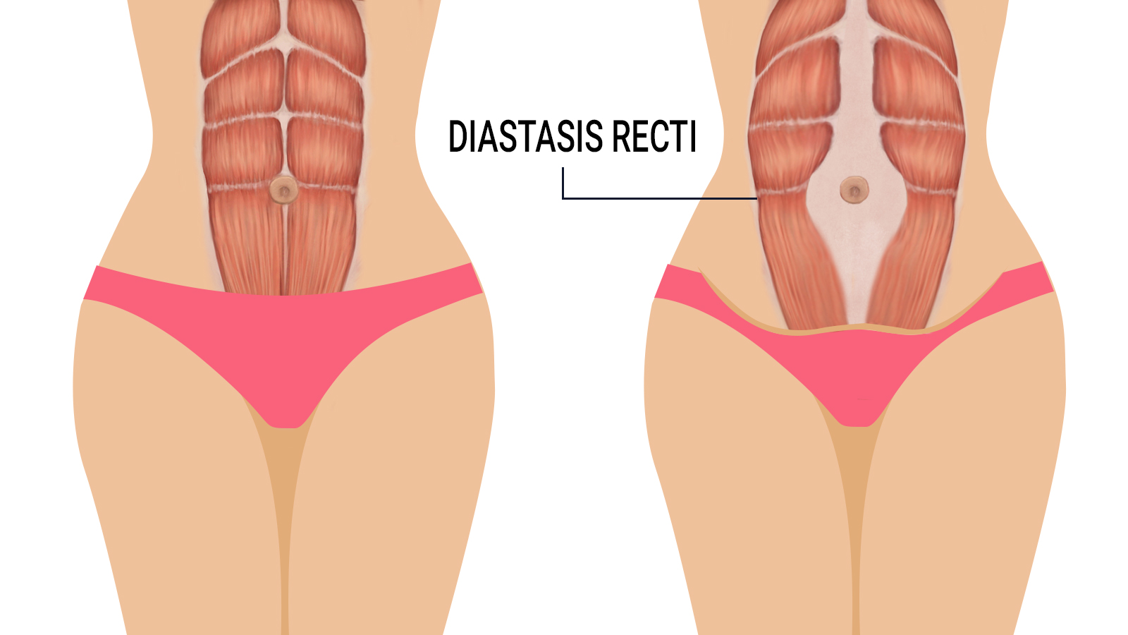 diastasis-recti-signs.jpg