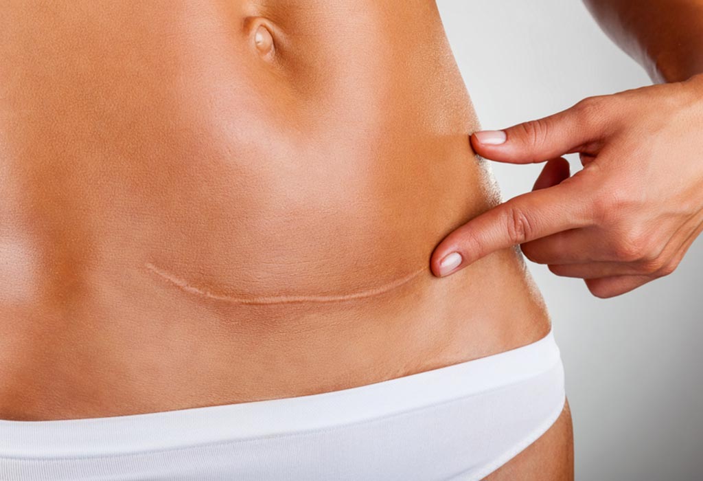 scar tissue and adhesion treatment | pelvic floor physical therapy